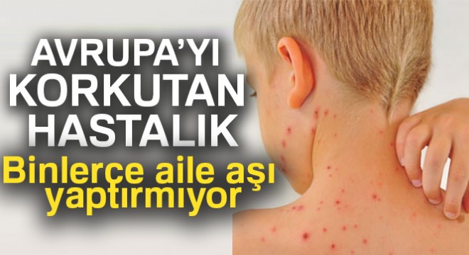 Avrupa'da kızamığa yakalanan 35 çocuk öldü